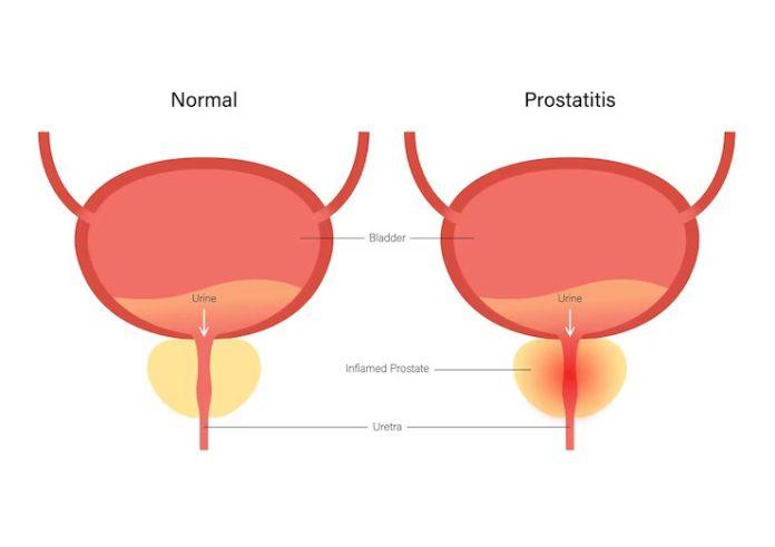 Enlarged Prostate