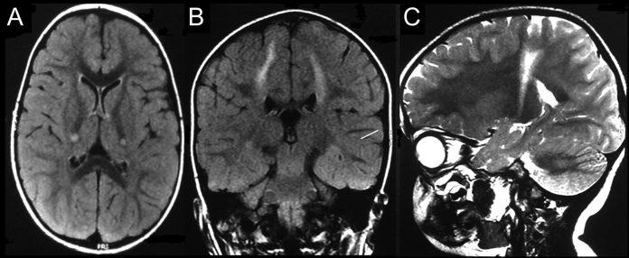 Krabbe Disease Treatment Market