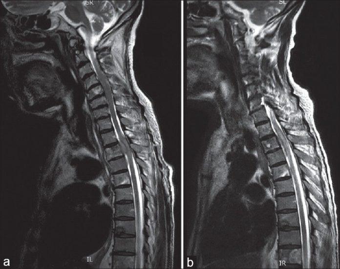 Metastases Spinal Tumor Market