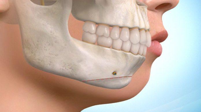 TMJ Implants Market