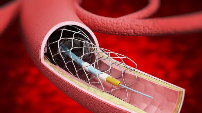 Vascular Stents Market