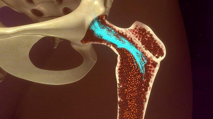 AL Amyloidosis Market
