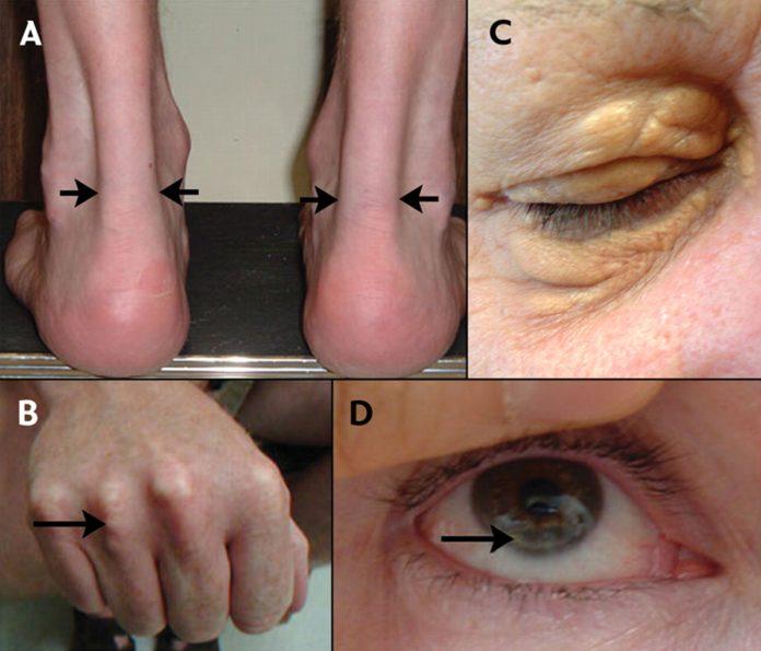 Heterozygous Familial Hypercholesterolemia Market