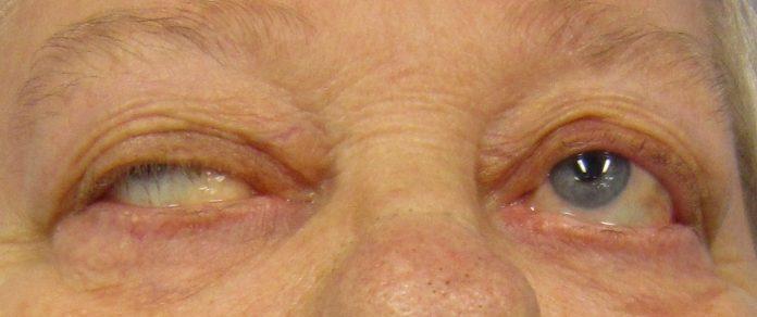 Myasthenia Gravis Market Size