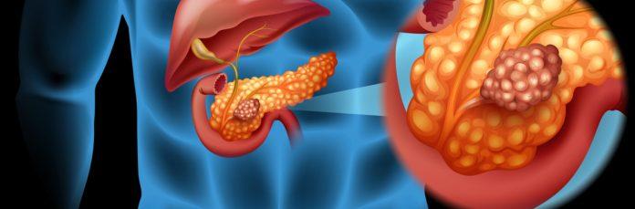 Pancreatic Cancer Market Size