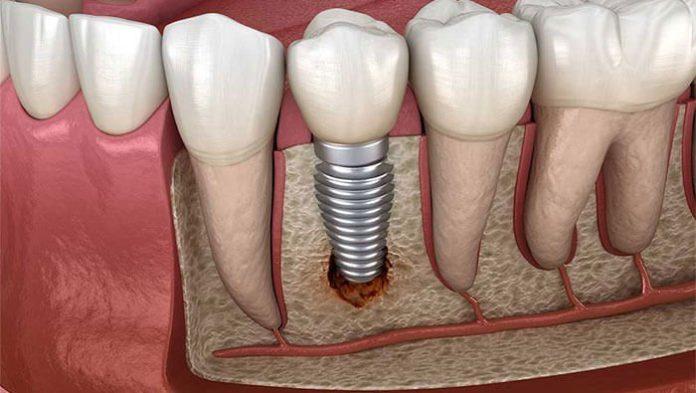 bone replacement graft for ridge preservation