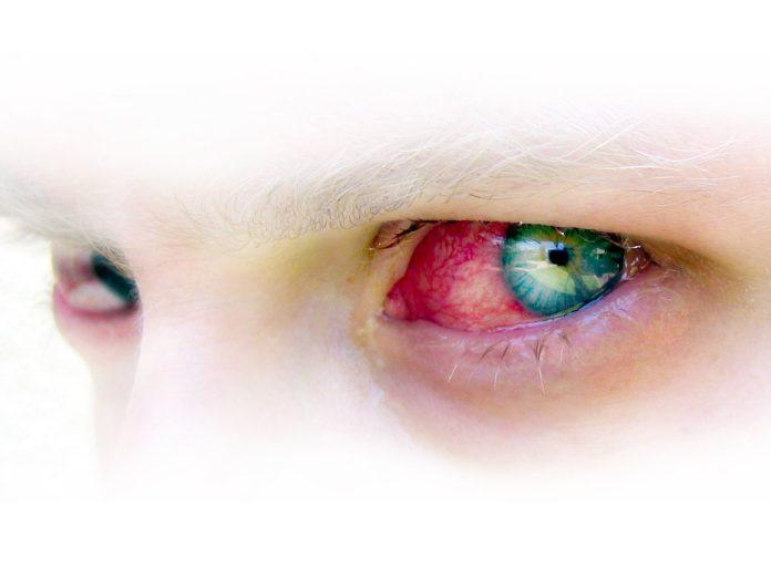Conjunctivitis