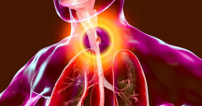 Esophageal Cancer Market