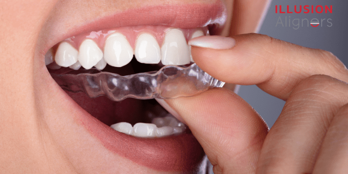 do clear aligners fix an overbite