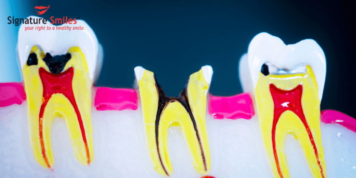 Need To Know About Root Canal Treatment in Mumbai