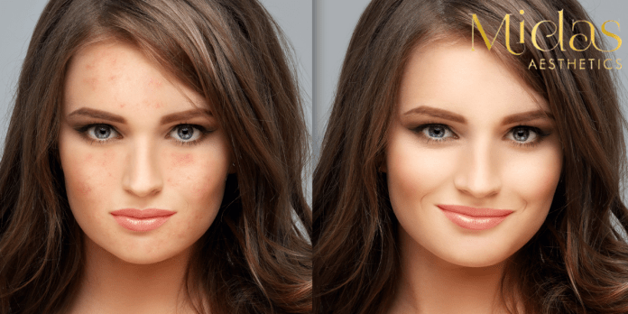 Effective ways to quickly remove acne scars