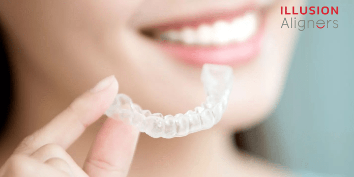 advantage of clear aligners