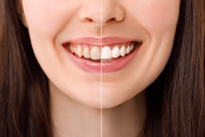 Teeth Whitening tomball tx