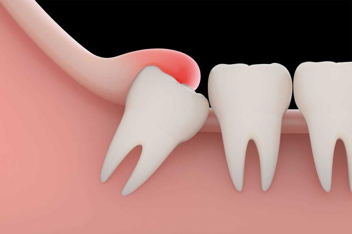 wisdom teeth removal