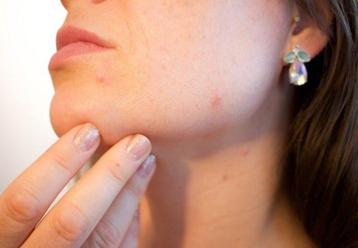 Acne Control Serum