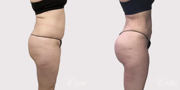 brazilian butt lift before and after