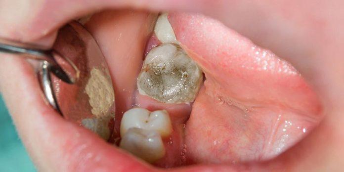 What is a Dead Tooth