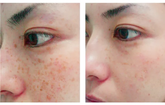 Diffuse Pigmentation