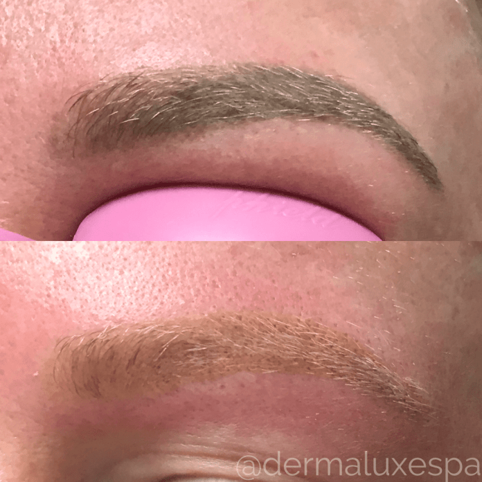 Microblading Removal