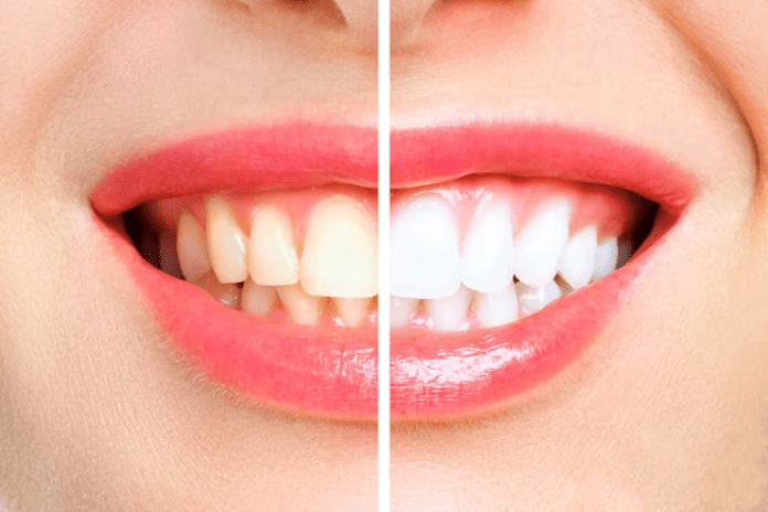 teeth whitening