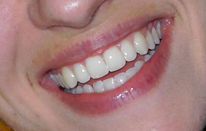 Teeth Whitening in rochdale