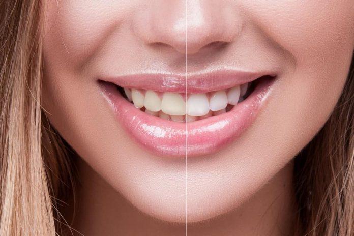 The Best Teeth Whitening in Dubai