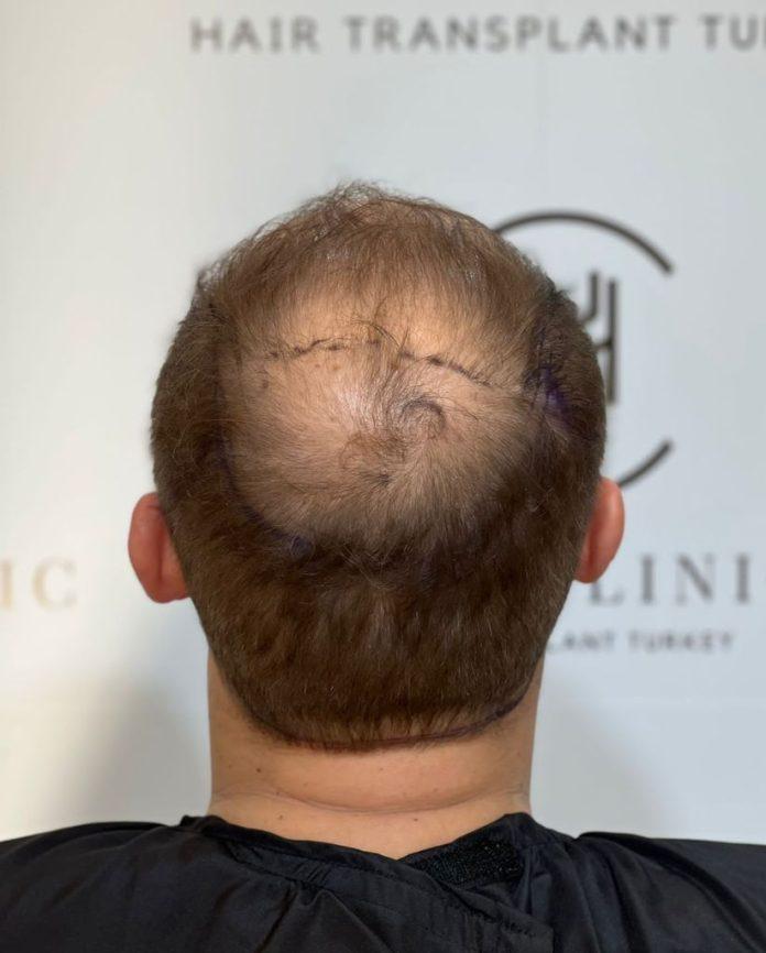 زراعة الشعر التاجي في دبي