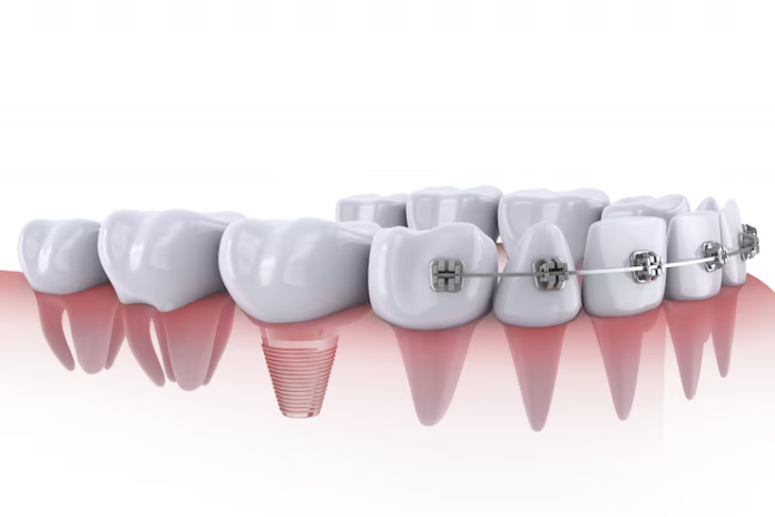 all on 4 implant harrisonburg va
