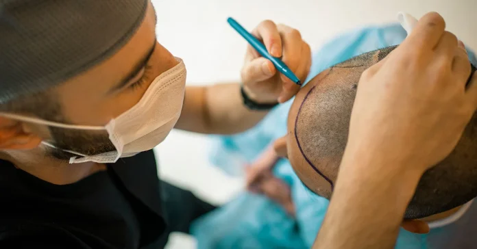 Hair transplant in Dubai