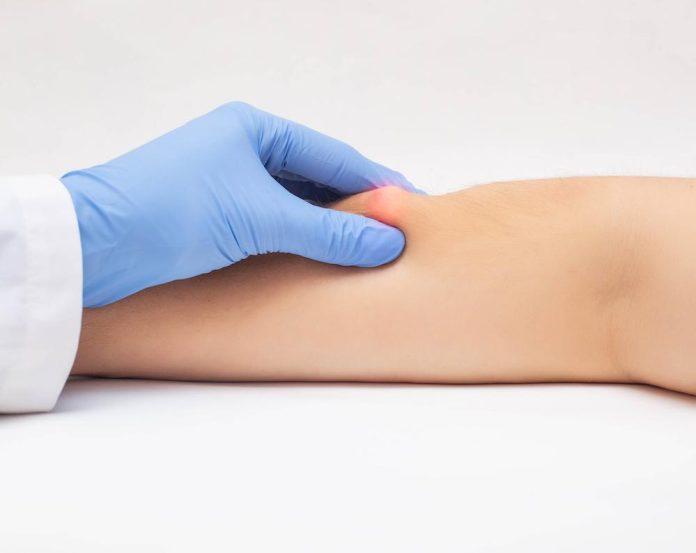 Lipoma Treatment in Dubai
