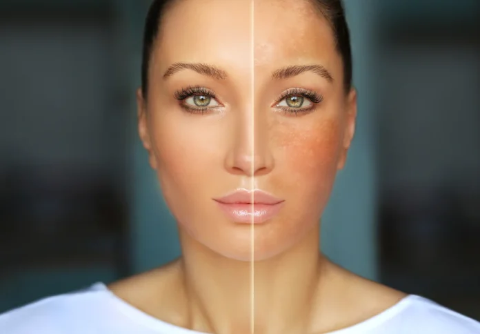 Skin Unification Treatment in Dubai