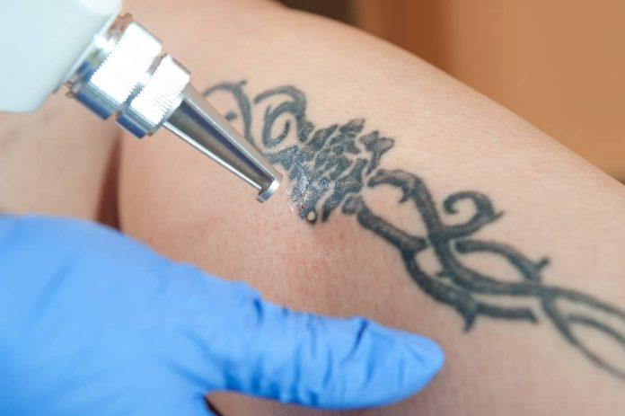 PicoSure Tattoo Removal in Dubai