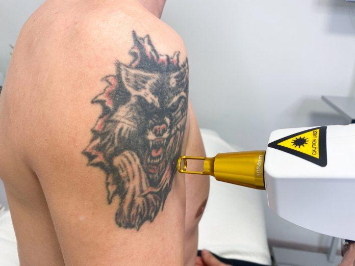 laser tattoo removal device in Dubai.