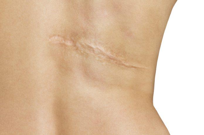 Post-Operative Scars in Dubai