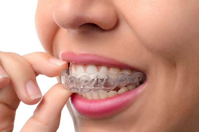 What are Invisible braces? Types and benefits