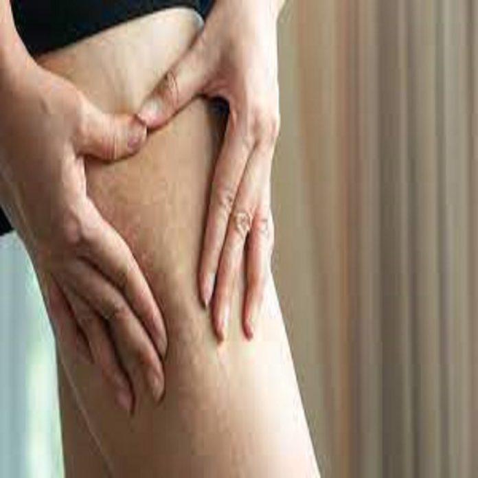 Stretch marks removal in Dubai