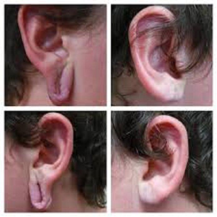 Earlobe Surgery in Dubai