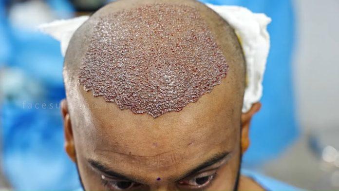 hair transplants in Abu Dhabi