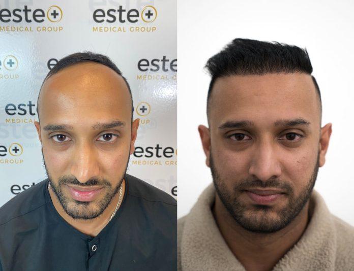 Hair Transplants in Riyadh
