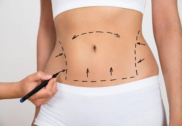 liposuction washington dc