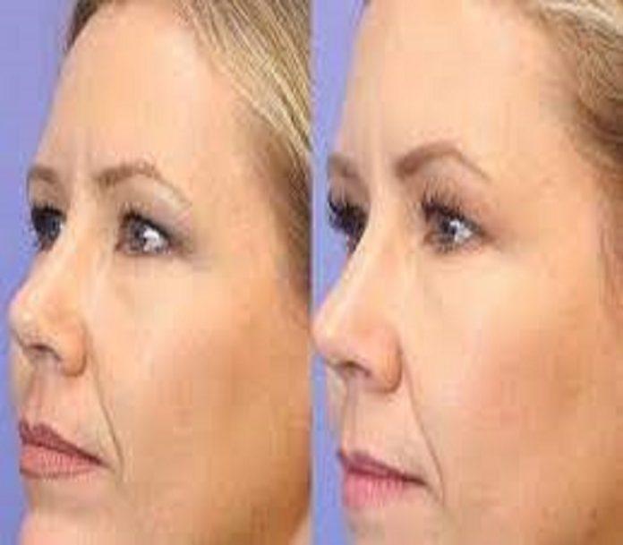 Xeomin treatment in Dubai