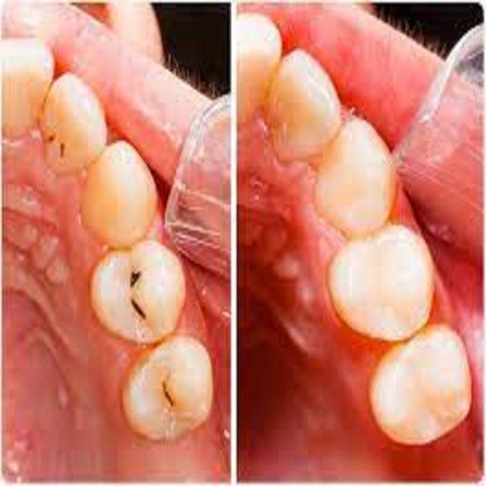 Dental filling treatment in Dubai