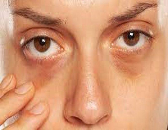 Treatment of dark circles in Dubai