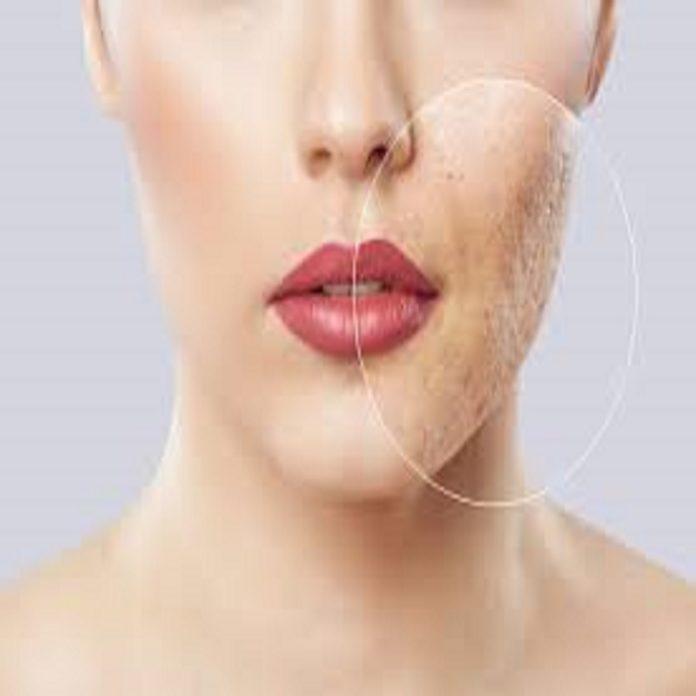 Laser scar removal Reduce scars in Dubai