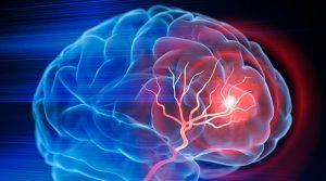 Types of Ataxia